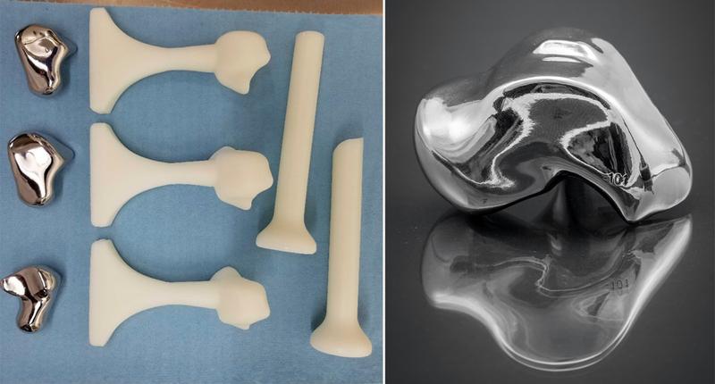 3D printed bone pieces are used to replace bone in the foot that has died.