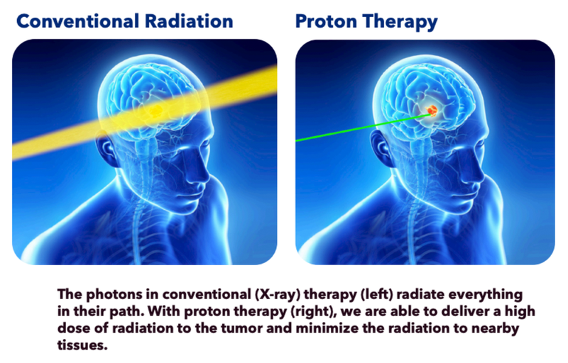 Illustration of the effectiveness of proton therapy vs conventional radiation therapy on brain tumor.