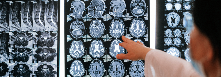 A doctor points to a series of brain scans on a light box.