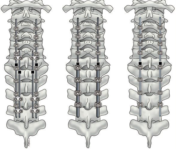 Illustration of the spine with variations of rods.