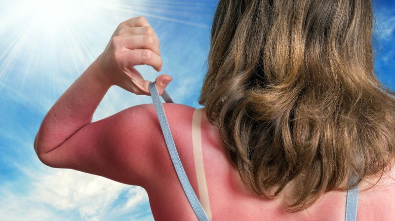 7 Natural Remedies to Soothe Sunburnt Skin