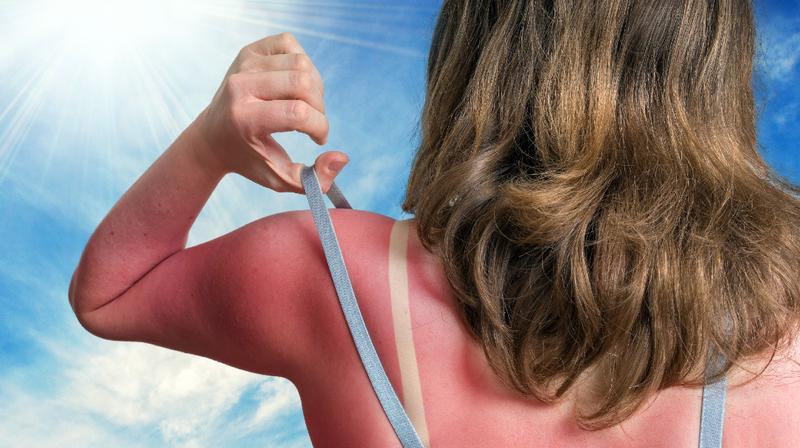 Extreme Sunburn Treatment: 11 Remedies [Medication & Natural] – Dr