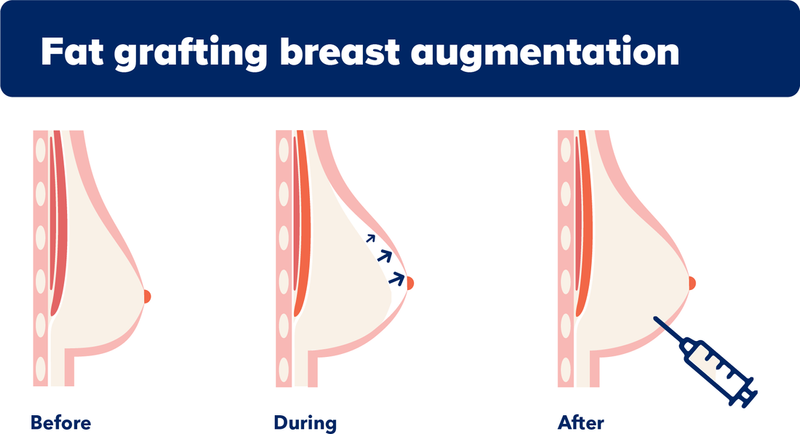Infographic outlining the process for fat grafting in the breast.
