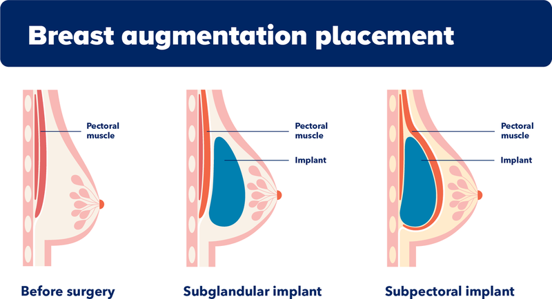 Infographic outlining the process for augmenting the breast using implants.