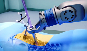 Robotic Spine Surgery Medical Illustration