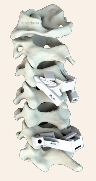 Medical illustration of a 3D printed cervical fusion device called MySpine.