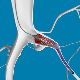 Anatomical illustration of the RevCore procedure - used to remove clots from existing stents. 