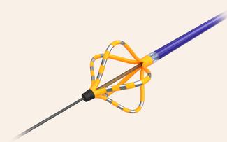 Illustration of a Farapulse Pulsed Field Ablation catheter