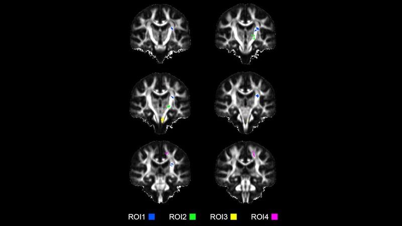 Brain scans that show white matter tracts can help with stroke rehabilitation.