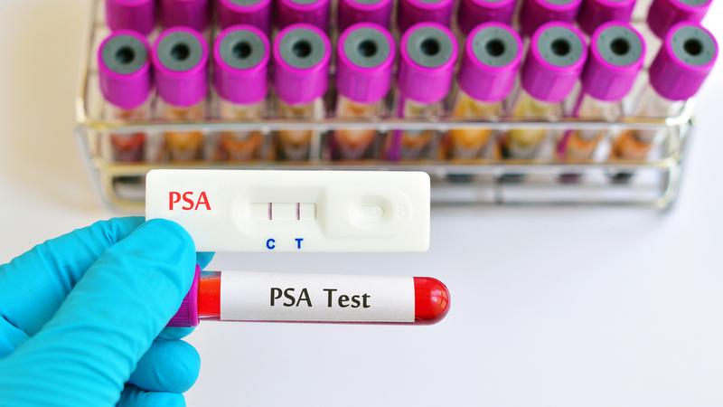 Close up photo of a hand holding a PSA test vial.