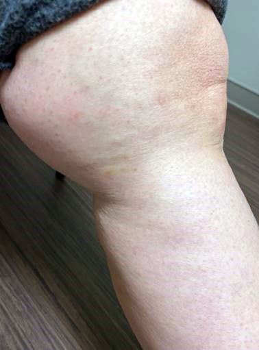 AFTER Sclerotherapy_patient1.jpg
