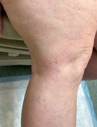 AFTER Sclerotherapy_patient2.jpg