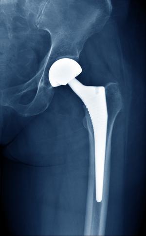 Xray film of an artificial hip