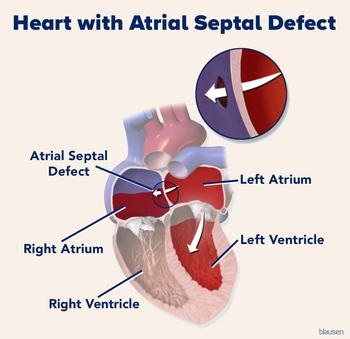 Medical illustration showing atrial septal defect of the heart.