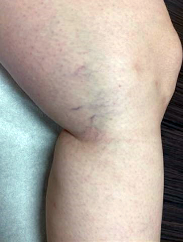 Sclerotherapy of spider veins - Vascular Care Centre