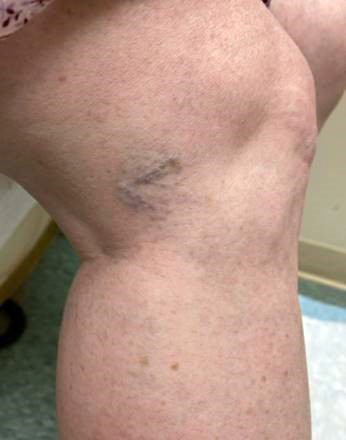 Sclerotherapy of spider veins - Vascular Care Centre