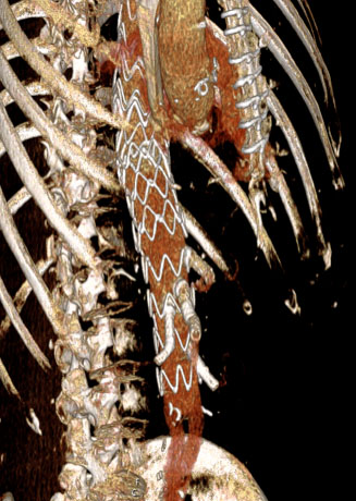 Close up photo of a FEVAR device as it would be used in a patient for complex aortic aneurysm treatment.