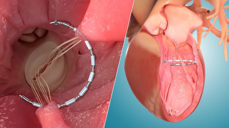 Medical illustration of the AccuCinch system for heart valve repair.