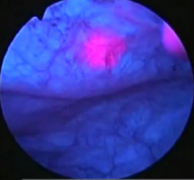 Blue light cystoscopy is used as an adjunct to white light cystoscopy to detect cancer in the bladder.