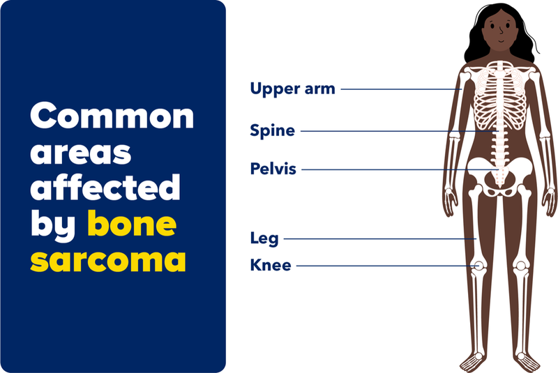 Infographic showing areas of the body that are commonly affected by bone sarcoma.