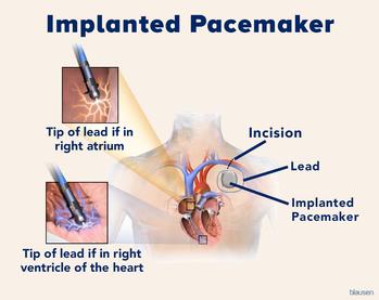 Medical illustration showing the location of an implanted pacemaker.