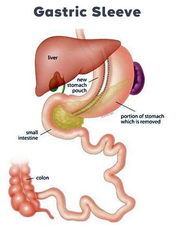 Medical illustration showing the internal organs after a bariatric gastric sleeve surgery.