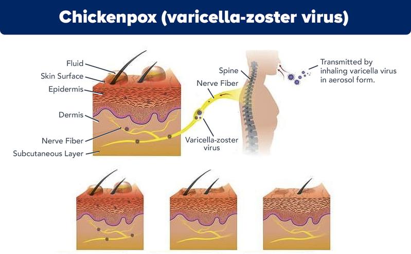 Infographic showing varicella-zoster virus