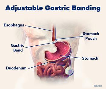 Medical illustration showing the location for placement of a gastric band after bariatric surgery.