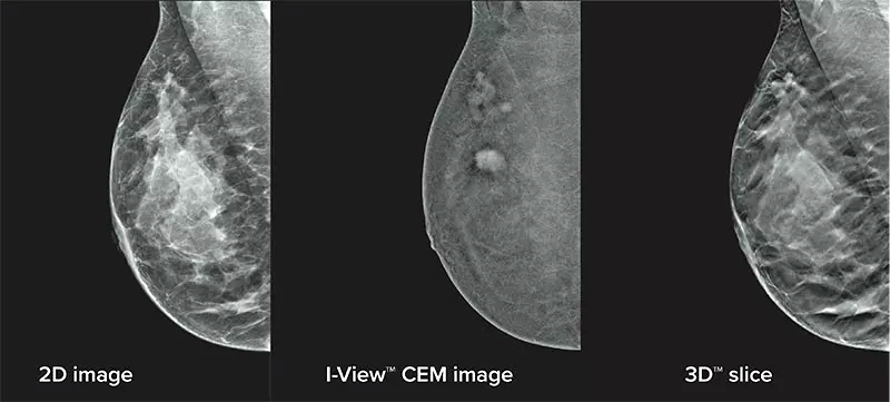 Enhanced mammogram imaging