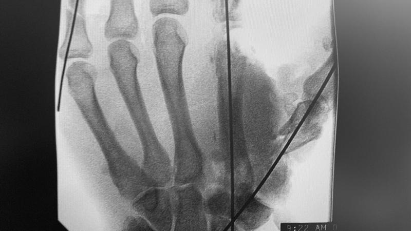 Xray of a hand injury resulting from mishandling fireworks.