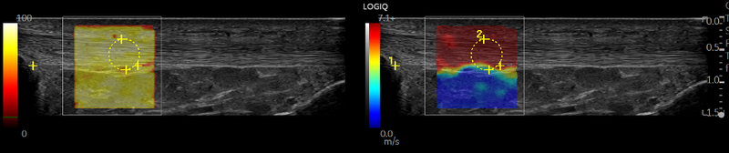 Patellar Tendon Elastography chart results.