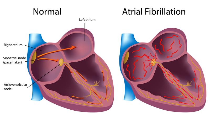 Illustration of atrial fibrillation