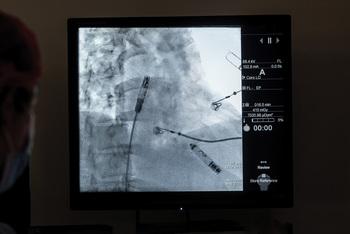 A close up of a computer screen showing the placement of a leadless pacemaker device in the cardiac electrophysiology lab.