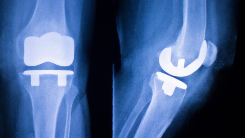 Xray of a joint repaired using metal hardware.