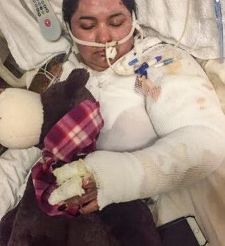 Evelyn Fernandez underwent successful burn treatment at MedStar Health.