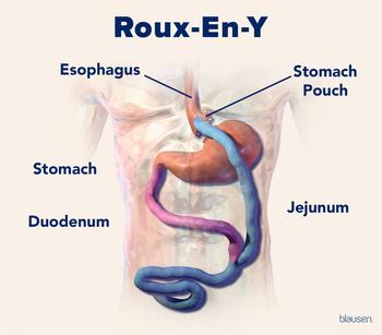 Medical illustration showing the internal organs after a bariatric Roux-en-Y surgery.