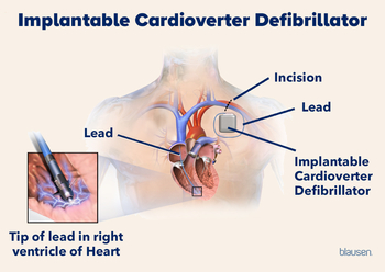 Medical illustration showing an implantable cardioverter defibrillator