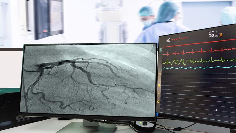 An angiogram image is displayed on a computer monitor in a cardiac catheterization lab.