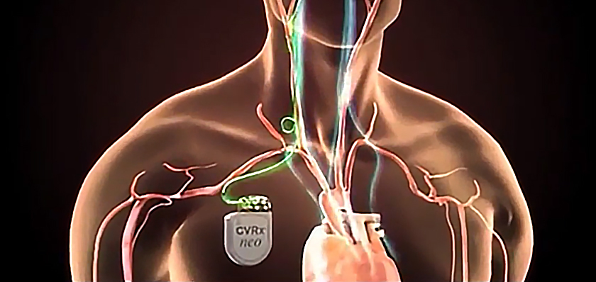 Medical illustration showing placement of a Barostim™ Baroflex Activation Therapy device.