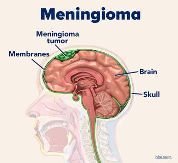 Medical illustration showing the location of a meningioma tumor in the brain.