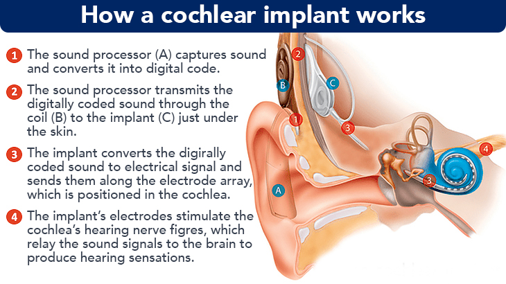Medical illustration and description of a cochlear implant and ear anatomy