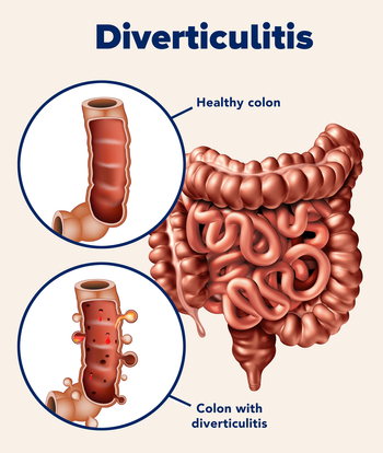 Medical illustration showing intestinal inflammation from diverticulitis.