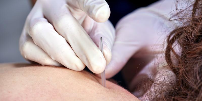 Close up photo of a medical professional giving a dry needling treatment to a patient.