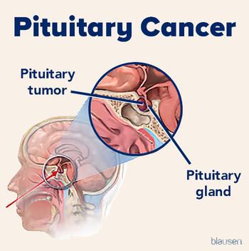 Medical illustration showing the location of a pituitary tumor.