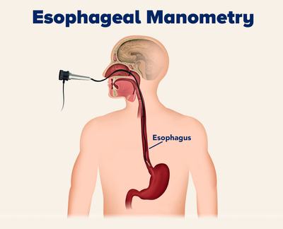 Medical illustration showing an esophageal manometry procedure.
