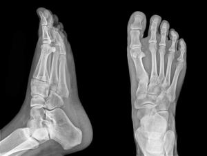 Xray of a person's foot