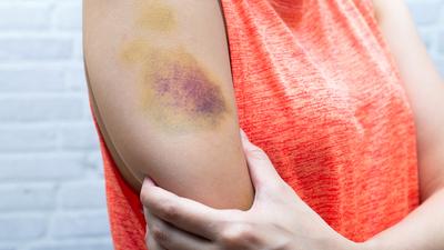 A woman holds her arm, which has a very large bruise.