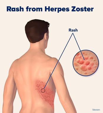 Illustration showing shingles rash