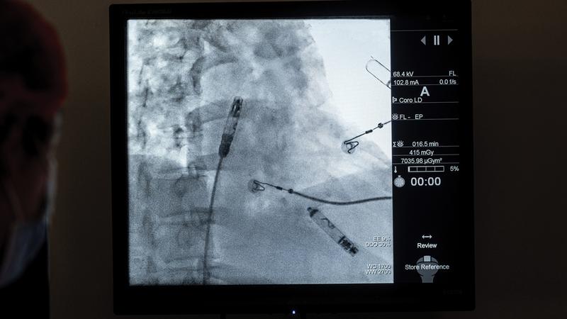 A close up of a computer screen showing the placement of a leadless pacemaker device in the cardiac electrophysiology lab.