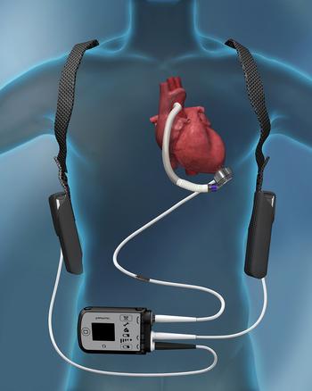 Medical illustration showing placement of an LVAD device